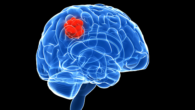 Image visualizing a brain with a mass developing inside. 