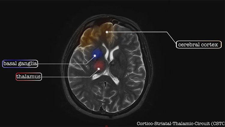 Brain MRI