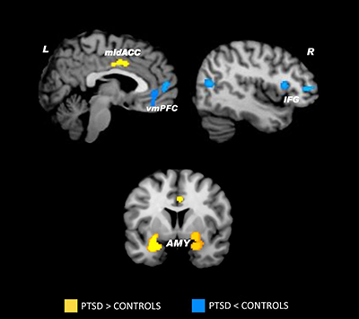 Brain Imaging Study of Person with PTSD and Control