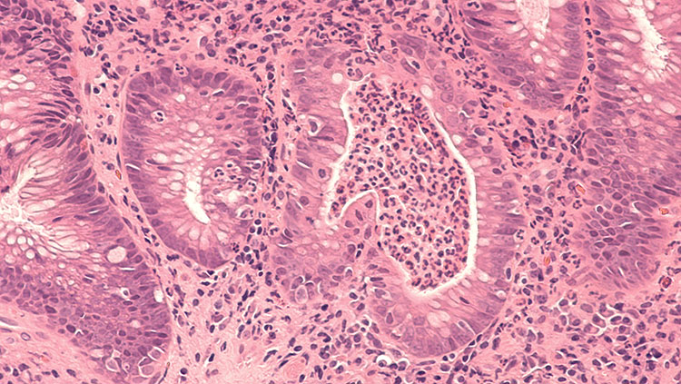Colon biopsy showing ulcerative colitis