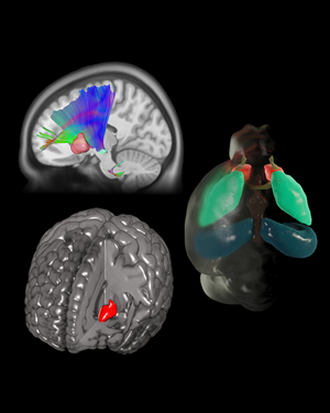 A mutation in a human axon guidance gene