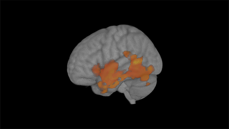 Brain Changes Associated With Low Level Cannabis Use in Teenagers