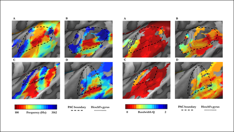 How Blindness Shapes Sound Processing