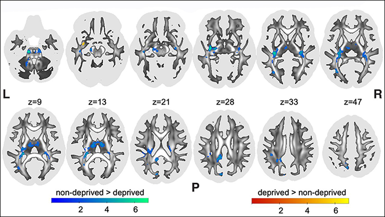 A Prospective Study of the Impact of Severe Childhood Deprivation on Brain White Matter in Adult Adoptees