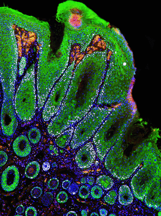 This image shows keratinocytes (green), proliferating cells (white), inflammatory cells (red), and cell nuclei (blue) associated with a skin tumor in a one-year-old mouse lacking PTEN, a protein that regulates cell growth and proliferation