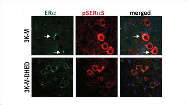 Estrogen Improves Parkinson’s Disease Symptoms