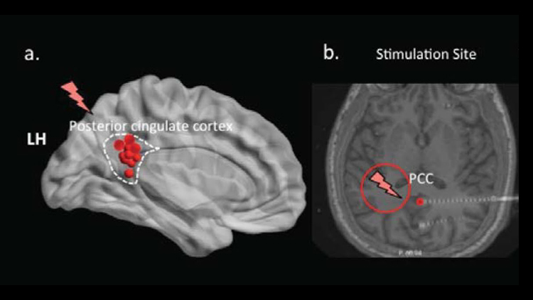 Deep Brain Stimulation Modifies Memory