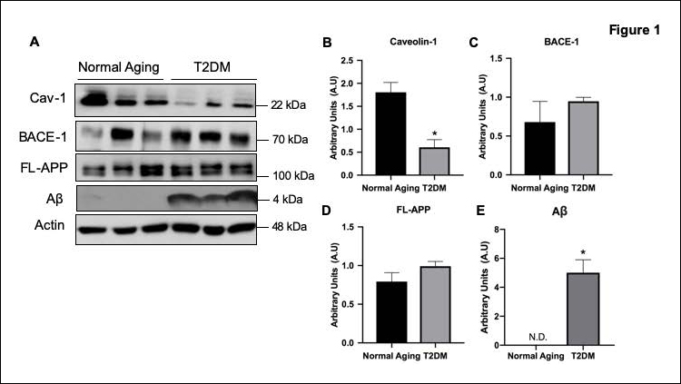 Potential target for diabetes-associated Alzheimer's disease