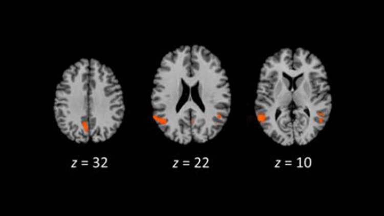Telling a story, no matter the medium, activated a “narrative hub.” This includes (from left to right) the posterior cingulate cortex, the temporoparietal junction, and the posterior superior temporal sulcus. Source: Yuan et al., Journal of Cognitive Neuroscience 2018