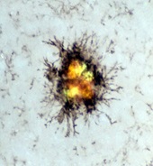 In Alzheimer’s Disease microglia surround the amyloid plaques and may clear the amyloid under the right conditions – as is the case with some of the immunotherapy drugs in Alzheimer’s.